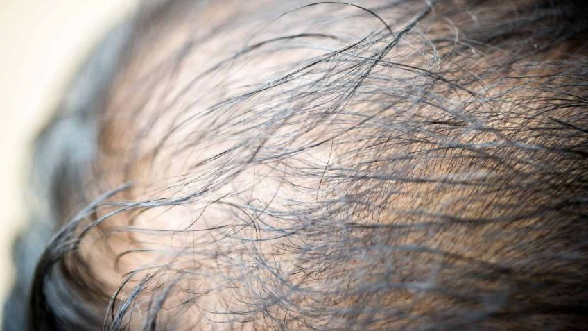  Bob secret kapsule protiv ćelavosti – prevara ili ne!