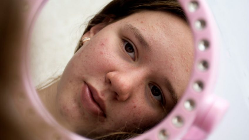  Cinkova mast za bubuljice: da li vam baš ona treba?