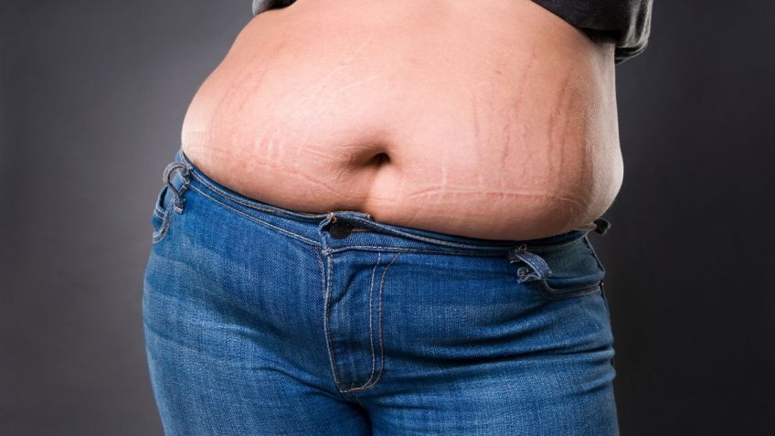  Kako ukloniti crvene strije i zašto one nastaju?