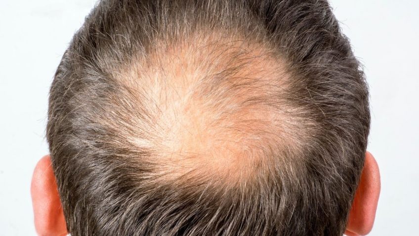  Opadanje kose na temenu – najbolja rešenja!