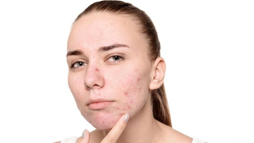  Potkožne bubuljice: vodič kroz sve uzroke i rešenja