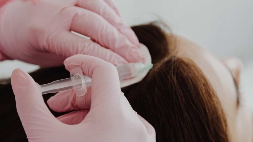  Biomelem Revitabion R10000 je bolji od transplantacije kose:ISTINA ili MIT!