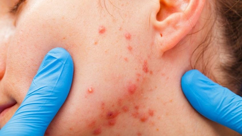  Benzoil peroksid gel za akne: kako deluje i da li leči akne!