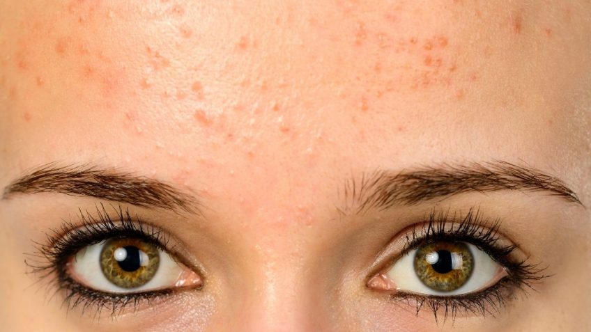  Bubuljice na čelu: uzroci i najlakša rešenja