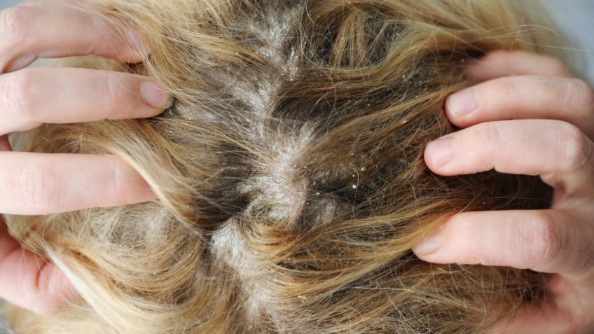 gljivice u kosi skalp