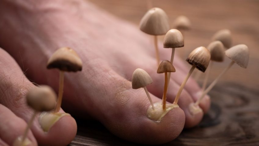  Najbolji lek za gljivice na noktima: preparati koji zaista deluju!  