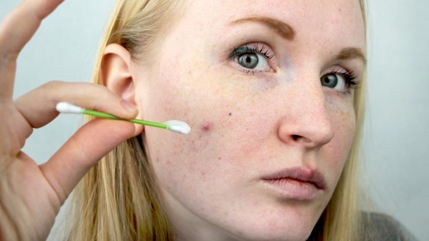  Duac gel za akne: uputstvo, cena i iskustva