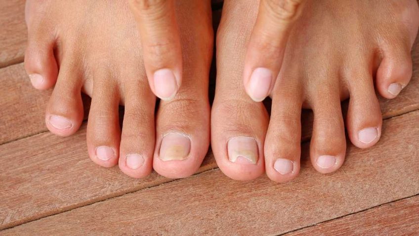  Scholl Fungal nail tretman: sva pitanja i odgovori!