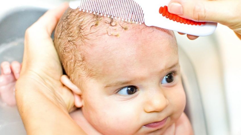  Šampon za temenjaču: zašto vam treba i koji su najbolji