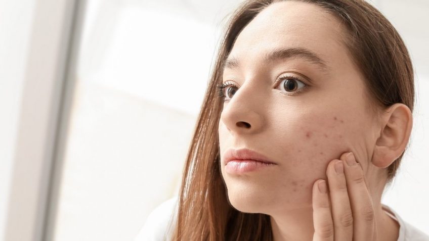  Preparati za bubuljice u trudnoći koje možete koristiti