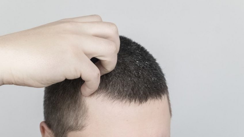 Hemel sampon protiv seboreje i opadanja kose