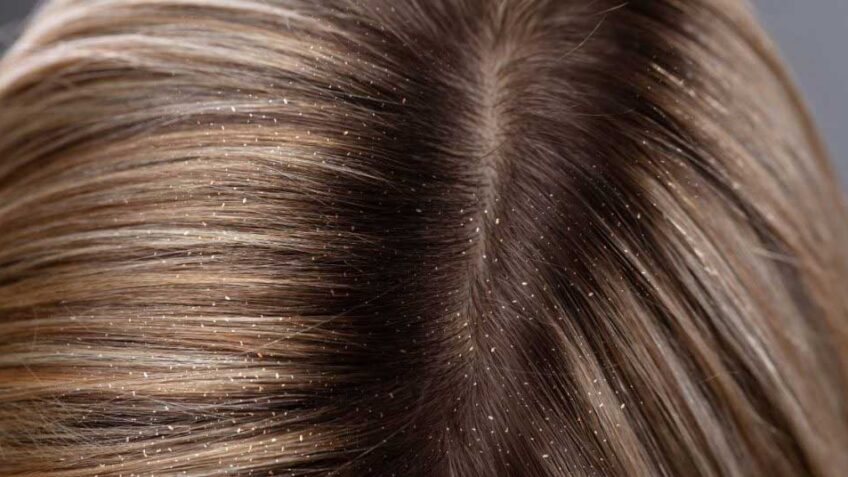  Otkrivamo! Kako se rešiti peruti u kosi!