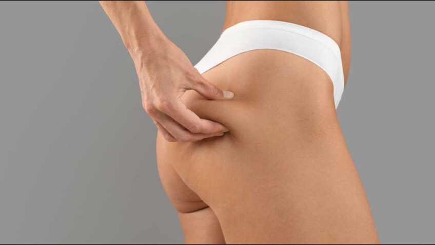  Saznajte konačno kako skinuti celulit na zadnjici