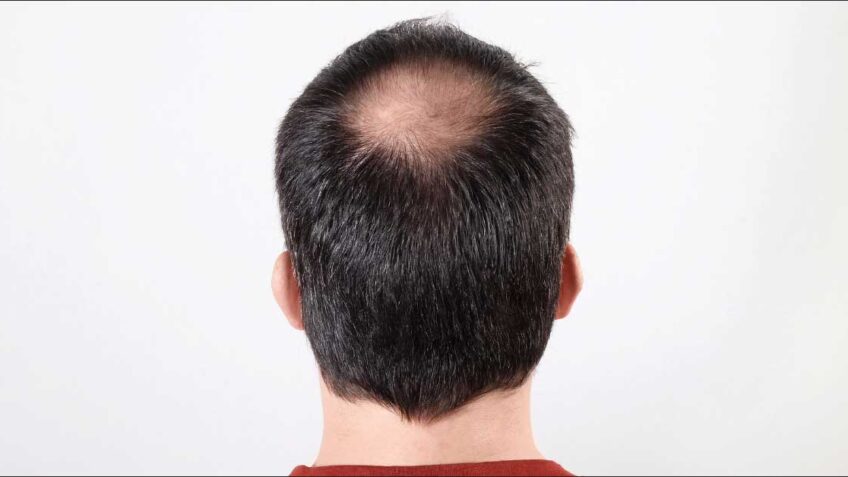  Opadanje kose kod muškaraca: lek i najefikasniji tretmani