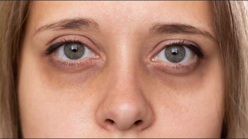  Tamni podočnjaci ne prolaze? Evo uzroka i rešenja!